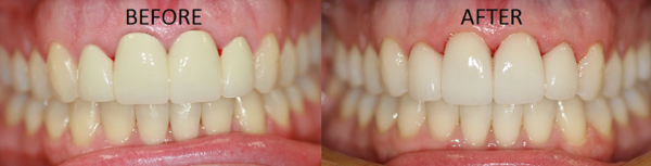 Four anterior connected crowns were replaced with individual porcelain restorations and Zoom whitening was performed on the rest of the teeth, transforming the smile!